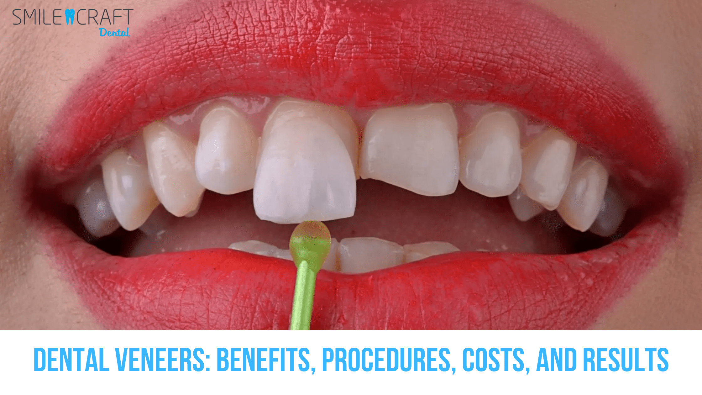 dental venner - benefits, procedure, cost etc