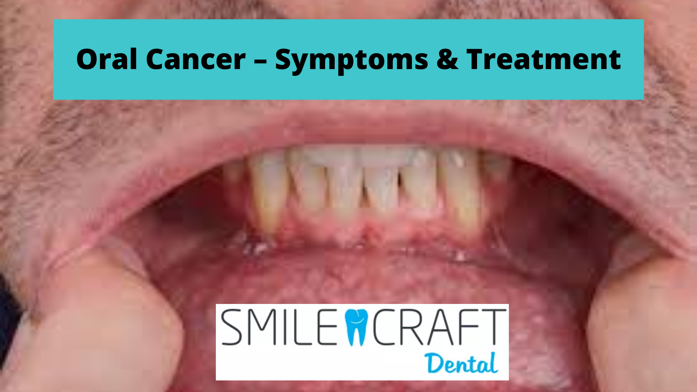 Oral Cancer – Symptoms & Treatment