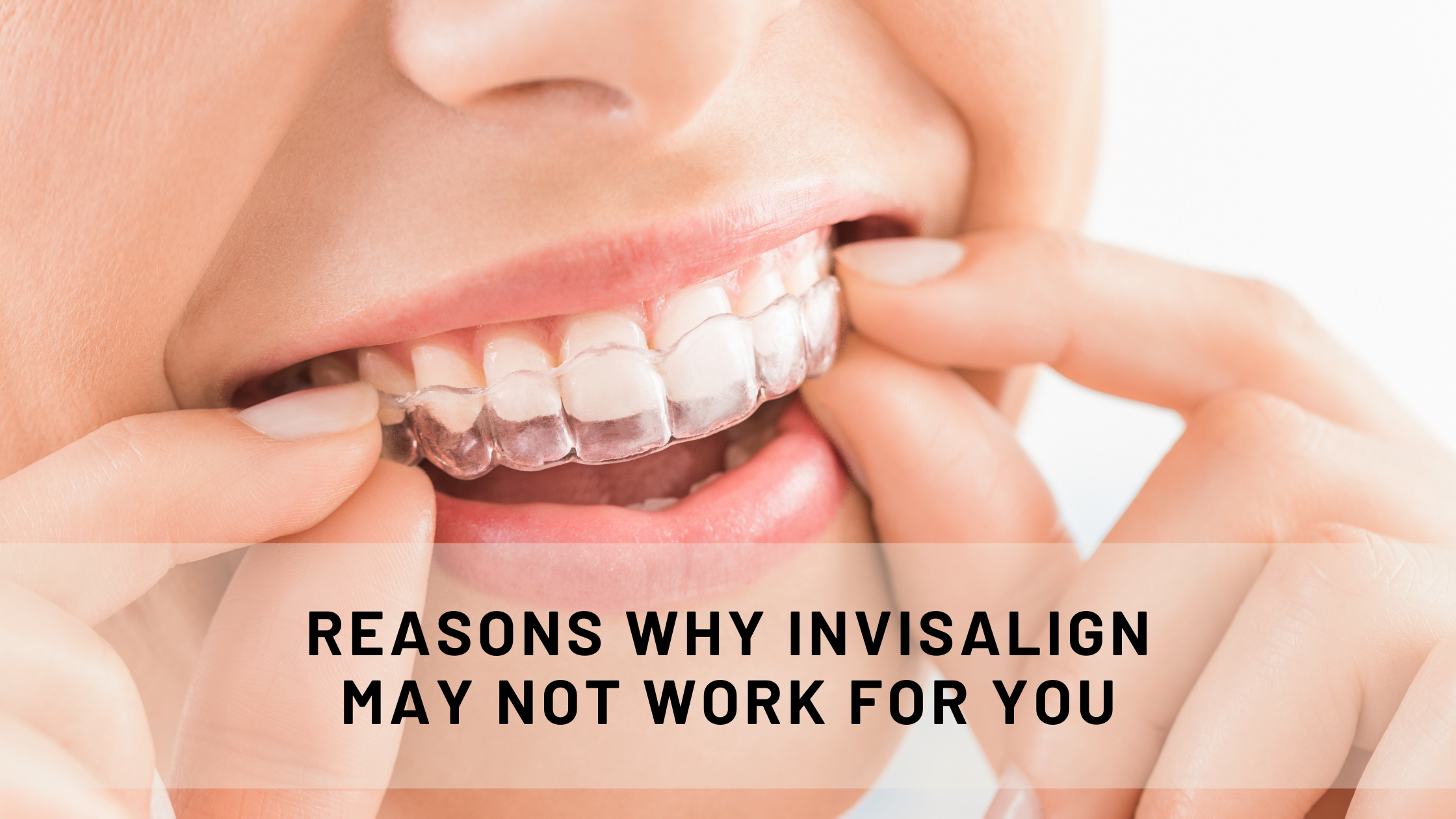 Reasons why Invisalign may not work for you