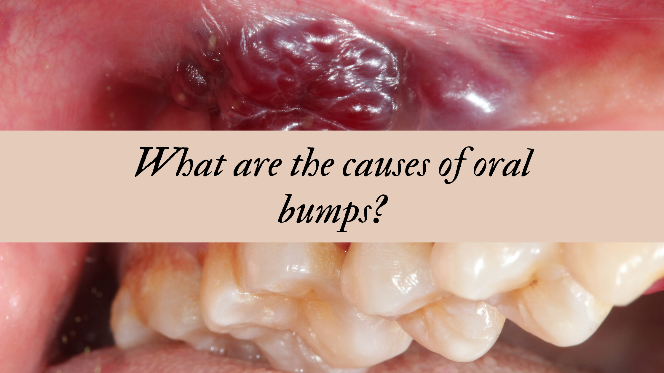 What are the causes of oral bumps