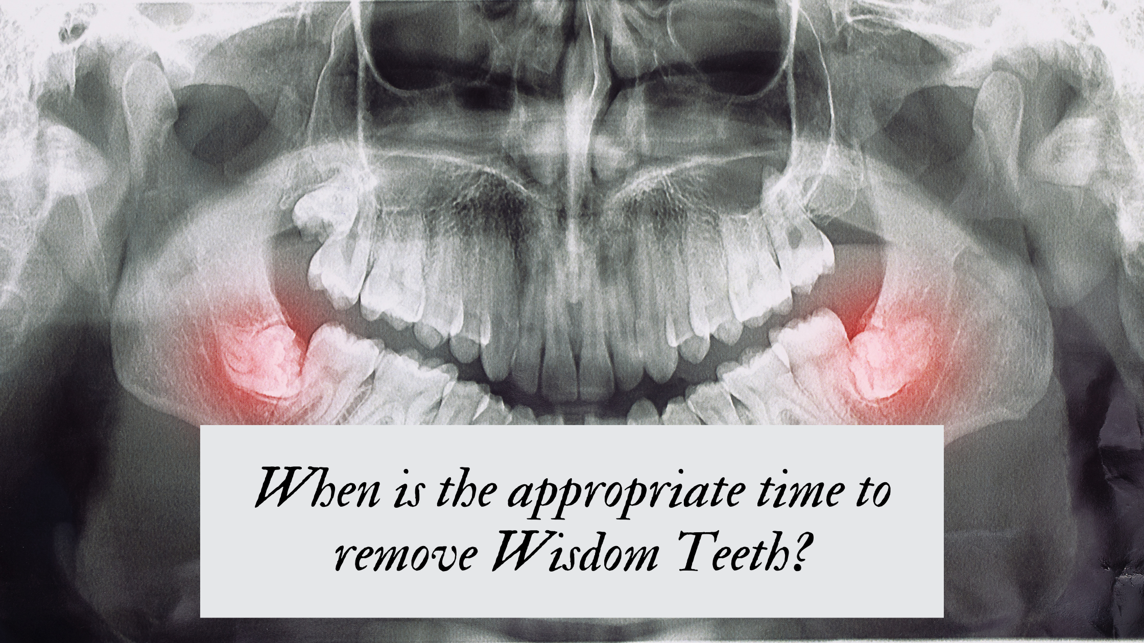 When is the appropriate time to remove Wisdom Teeth