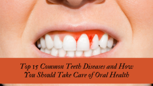 Top 15 Common Teeth Diseases and How You Should Take Care of Oral Health