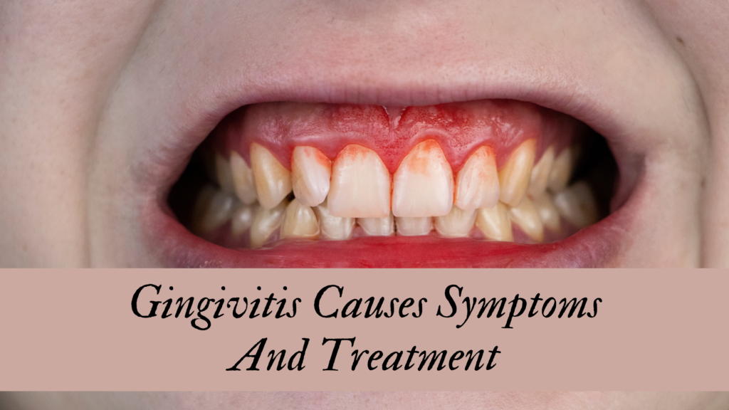 Gingivitis Causes Symptoms And Treatment