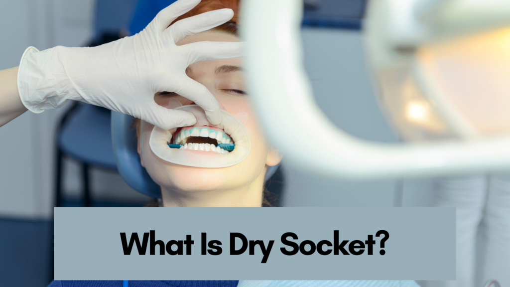 What Is Dry Socket?
